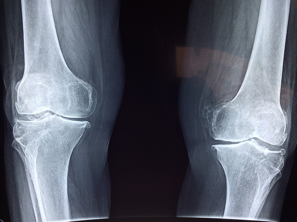 Radiografia artrosi ginocchio