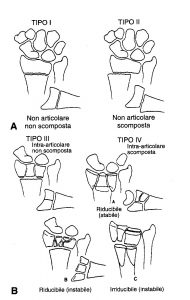 classificazione frattura polso