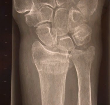 radiografia frattura polso