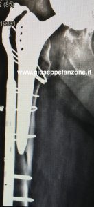 placca cerchiaggi femore