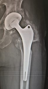 osteolisi periprotesica