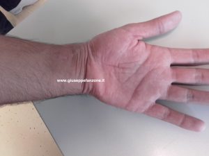 cicatrice intervento polso