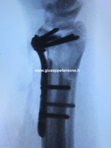 RX placca volare polso