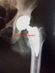 Radiografia protesi totale anca